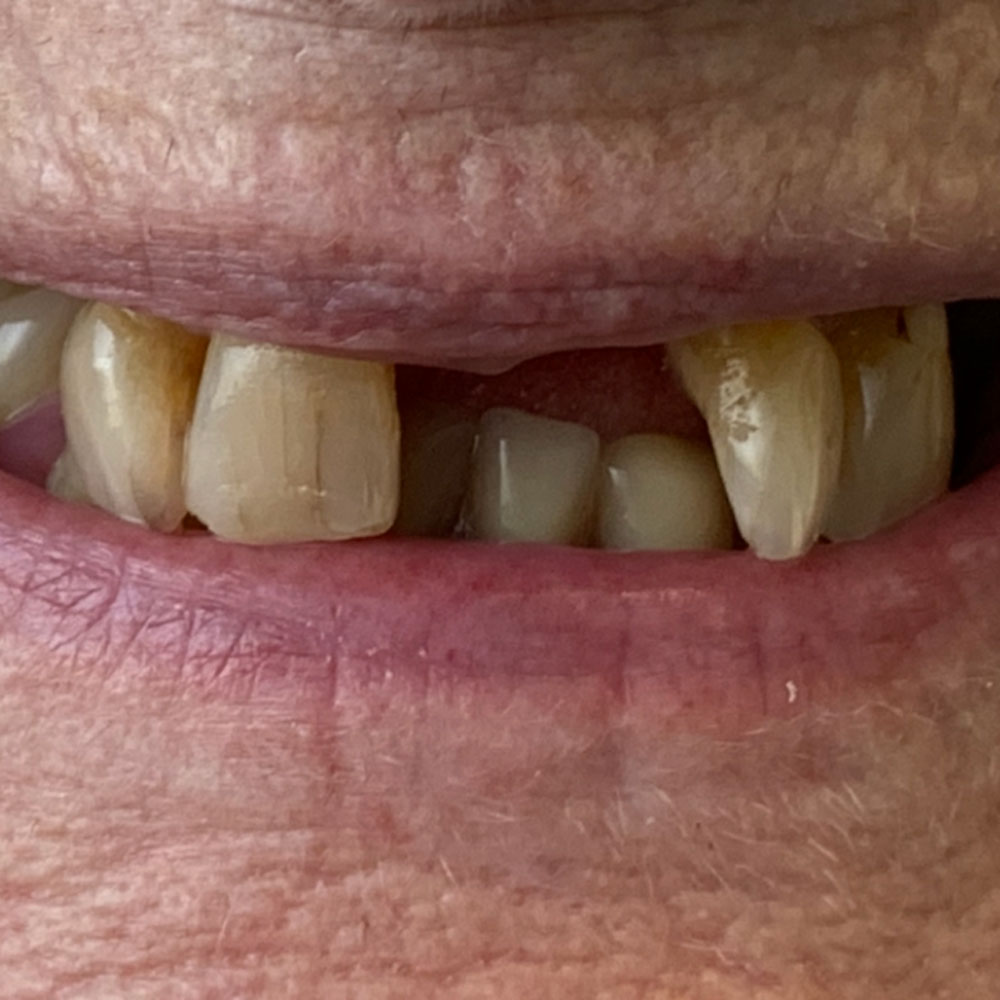Partial dentures, before - The Denture Clinic, Canterbury